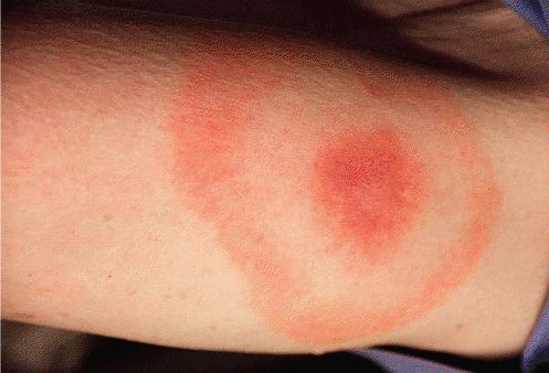 проявления болезни Лайма