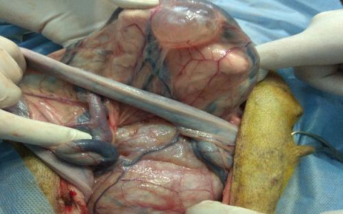 Новообразования (опухоли) яичников: заболеваемость и факторы риска