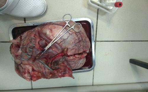 Новообразования (опухоли) яичников: заболеваемость и факторы риска